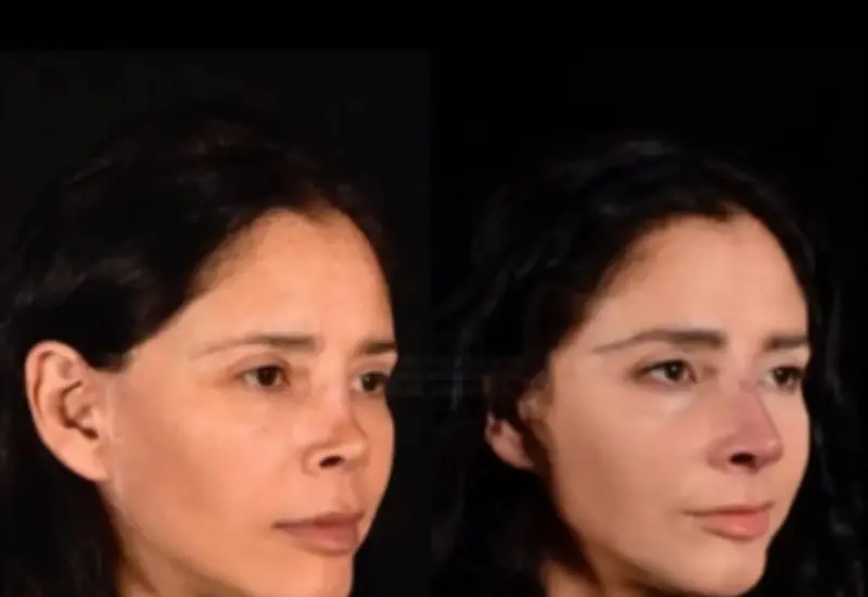 Cirugías estéticas fallidas derivaron en graves secuelas faciales.