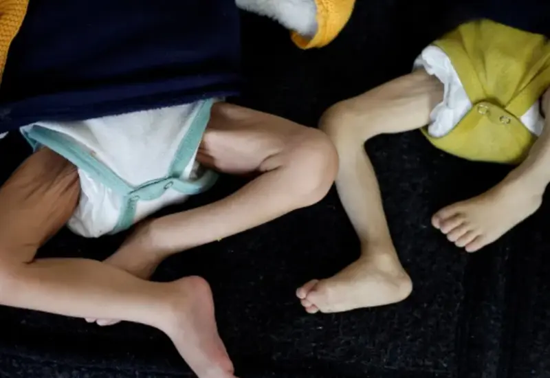 Un recién nacido en un hospital de Gaza presenta malformaciones congénitas, como reflejo de la crisis sanitaria por nacimientos con complicaciones en la región.