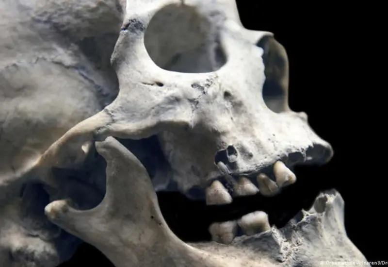 Evidencia arqueológica de una exitosa operación maxilofacial realizada hace 2,500 años, intervención que la paciente sobrevivió y le permitió recuperarse.