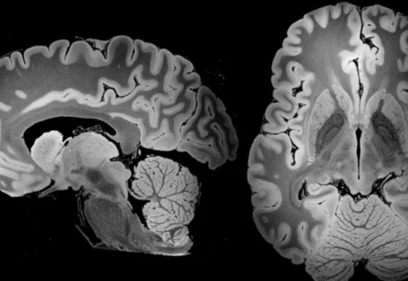 Ilustración conceptual que representa cómo las partículas de plástico logran infiltrarse y contaminar el tejido del cerebro humano sano.
